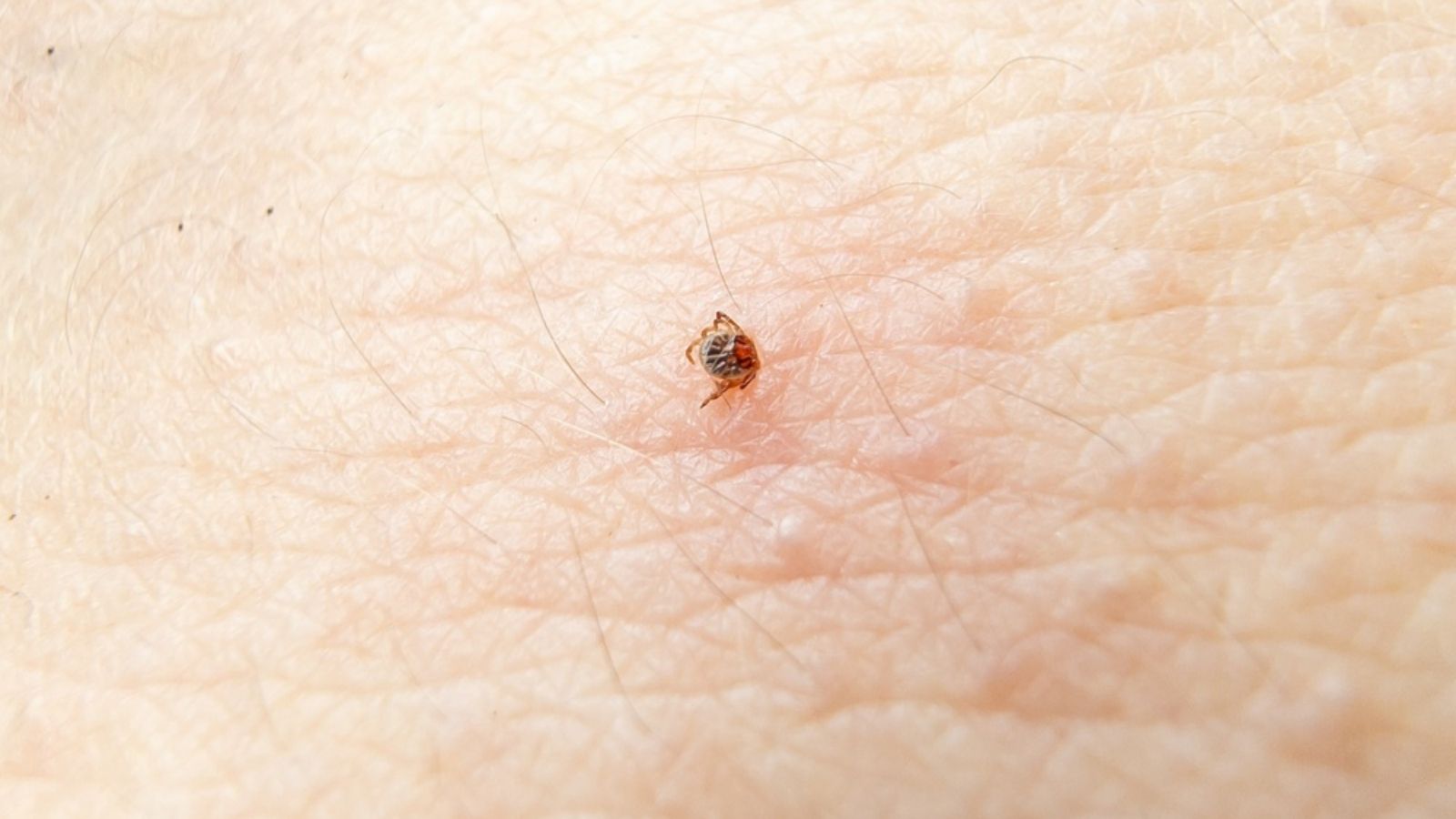 tick bite on human